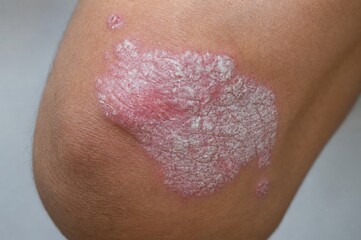 Fototapeta premium Close-up of chronic plaque psoriasis on outer elbow with red inflamed skin and silvery scales