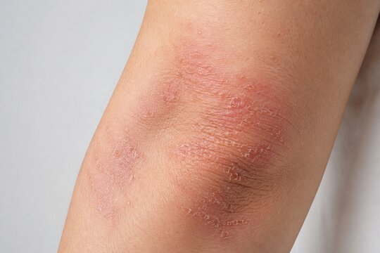 Red dry irritated skin rash on elbow close up
