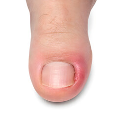 Fototapeta premium Ingrown toenail medical 3D anatomy render showing inflamed big toe nail margin with redness and swelling, isolated on white background for healthcare, podiatry, medical education and patient education