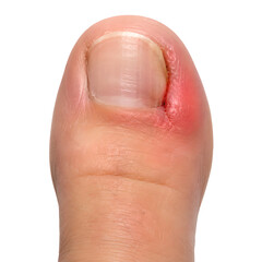 Fototapeta premium Ingrown toenail medical 3D anatomy render showing inflamed big toe nail margin with redness and swelling, isolated on white background for healthcare, podiatry, medical education and patient education