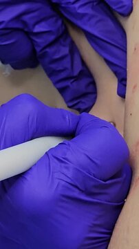 Professional removal of papillomas and moles with electrocoagulation procedure in dermatology clinic. overweight European woman on the surgical table. moles papillomas neoplasms on the body