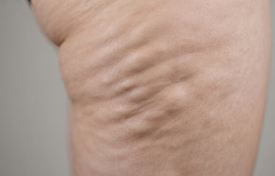 Severe Cellulite Orange Peel Texture on Thigh and Buttocks Skin