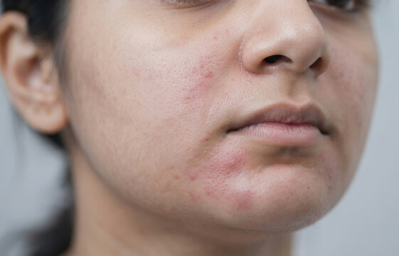 Perioral dermatitis with red inflammatory papules and bumpy rash around female mouth and chin area