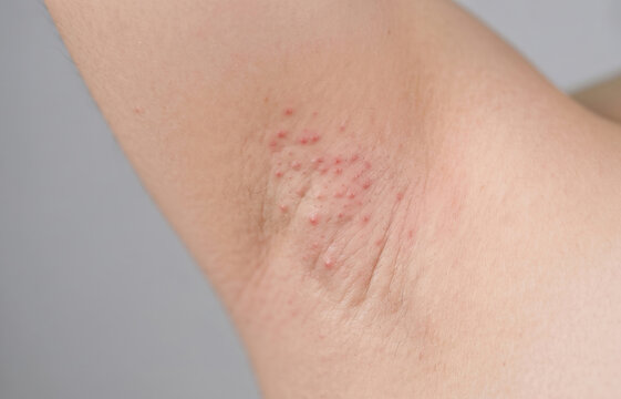 Acute axillary folliculitis with red inflamed papules and razor bumps in human underarm region