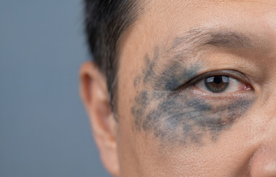 Close up of Nevus of Ota showing blue grey hyperpigmentation on the periorbital face skin and eye
