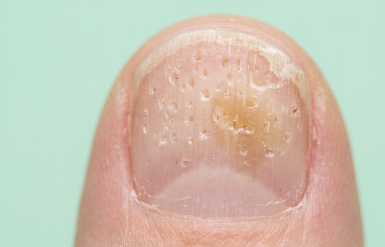 Macro Close Up of Nail Psoriasis Pitting and Onychomycosis Fungal Infection
