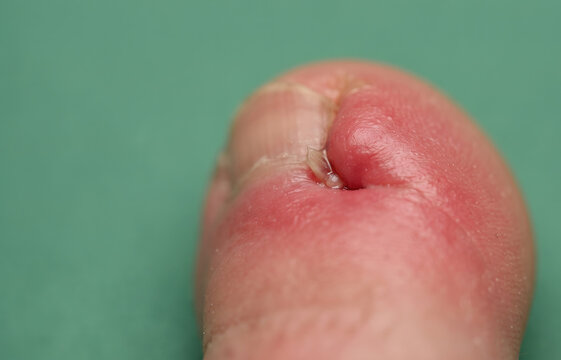 Close Up of Infected Ingrown Toenail Paronychia with Severe Inflammation