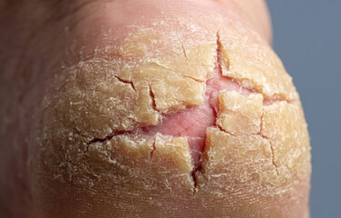 Fototapeta premium Severe hyperkeratotic heel fissures and deeply cracked feet skin revealing red dermal layer under callus