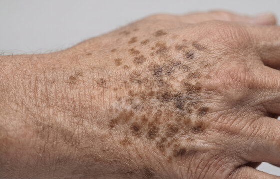 Multiple solar lentigines sun spots and hyperpigmented age spots on aging elderly male hand dorsum