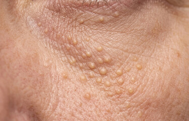 Fototapeta premium Dense multiple eruptive syringoma nodules and milia cysts on the periorbital and lower eyelid skin