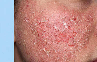 Fototapeta premium Severe facial eczema with extensive erythema skin cracking and dry peeling flakes on human cheek