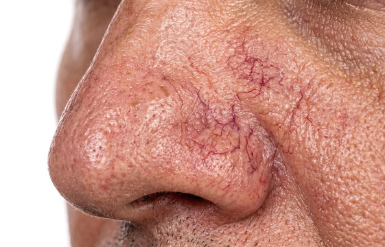 Close Up of Telangiectasia Broken Capillaries and Spider Veins on Nose