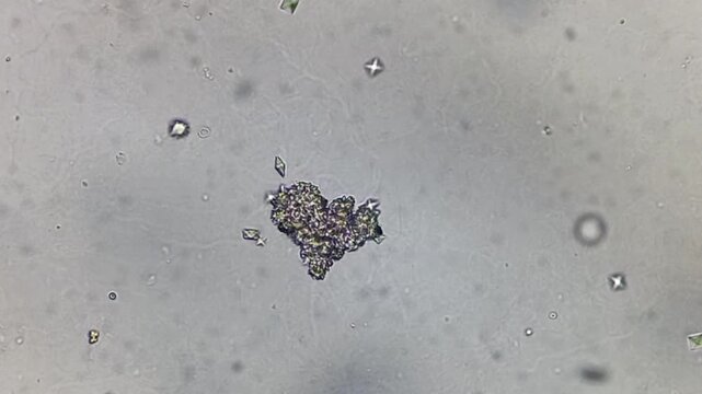 Microscopic urinalysis showing calcium oxalate and also bacteria. 