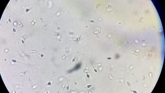Microscopic footage of human sperm cells. Normozoospermia normal sperm count. 