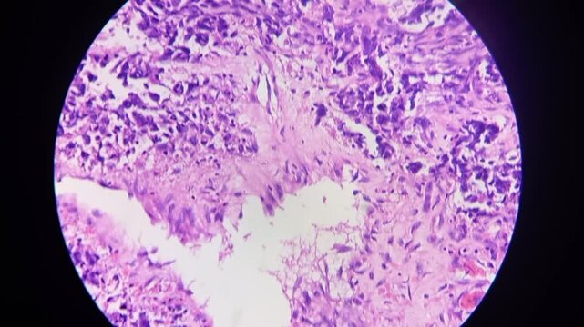 Histopathology of right breast lump. HPE: Infiltrating ductal carcinoma (NST), bloom-richardson nuclear grade-II. Negative Estrogen receptor, Progesterone receptor, HER-2.