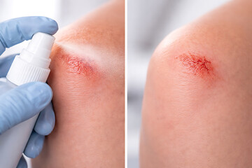 Fototapeta premium Antiseptic spray treatment for minor knee abrasion in clinical first aid care