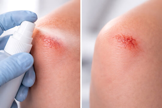 Antiseptic spray treatment for minor knee abrasion in clinical first aid care