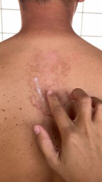 Slow motion vertical close up video of a woman applying anti-itch ointment cream to a large red ringworm rash on her bare back to treat the fungal skin infection.