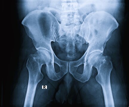 Frontal AP view pelvis X-ray scan displaying hip joints and iliac bone structure