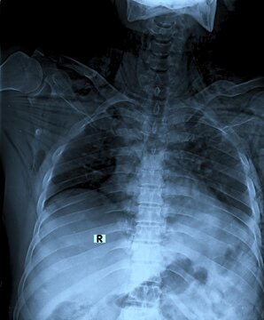 Frontal AP view pelvis X-ray scan displaying hip joints and iliac bone structure