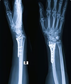 Radiography of radius and ulna forearm fracture with surgical plate and screw fixation