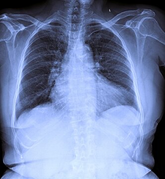 Frontal chest X-ray radiograph displaying lung fields rib cage and heart shadow