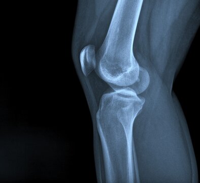 AP and lateral knee X-ray displaying total knee replacement prosthetic implant joint