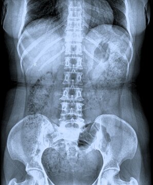 Lumbar spine radiography AP and lateral view showing lumbar vertebrae and sacrum anatomy