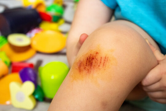Scraped knee of a child close up with iodine antiseptic. Little toddler boy or girl with fresh painful skin abrasion on leg after fall injury at home playground, medical first aid concept.