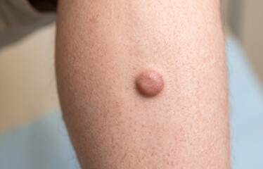 Fototapeta premium Macro view of a raised dermatofibroma cyst or benign skin nodule on human limb