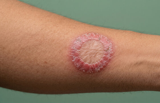 Close up of a classic ringworm tinea corporis fungal infection plaque on arm