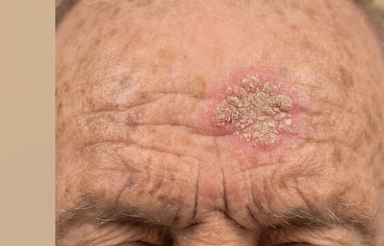 Macro close up of actinic keratosis or squamous cell carcinoma skin lesion on senior forehead