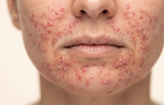 Macro close up of severe perioral dermatitis and red crusty eczema rash around mouth