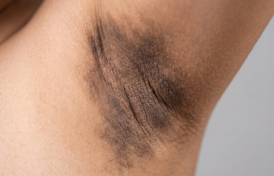 Macro close up of acanthosis nigricans dark hyperpigmentation on human underarm skin