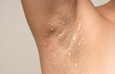 Fototapeta premium Close up of a human armpit heavily covered in sweat drops showing hyperhidrosis condition