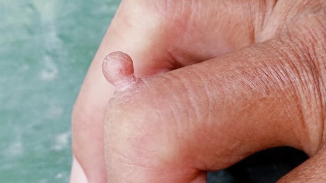A wart is a small, rough growth on the skin caused by infection with the human papillomavirus (HPV). It is usually harmless and non-cancerous, but can be bothersome or cosmetically unwanted.