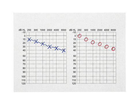 Audiogram hearing test chart result showing decibel loss levels with blue X and red circle graph markings for ear examination diagnostic health care monitoring and audiology medical assessment.