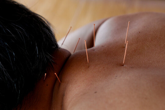 Acupuncture session to relieve pain in the shoulder and back