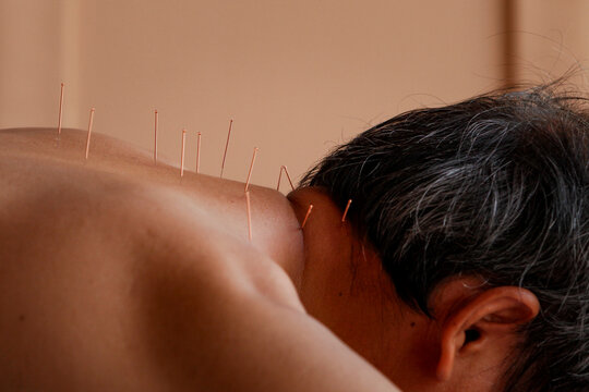 Acupuncture session to relieve pain in the shoulder and back