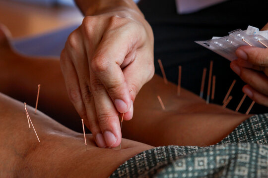 Acupuncture session to relieve pain in the knee joints