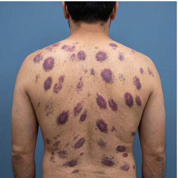Male patient's back shows widespread dark purple skin lesions and rash symptomatic of severe medical conditions.