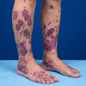 Human legs display widespread dark purple purpura and vasculitis lesions on a blue background in a medical clinic.