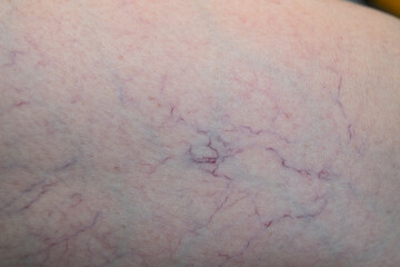 Fototapeta premium Macro photo showing broken capillaries and spider veins on human leg skin. Medical concept of vascular health and dermatological condition.