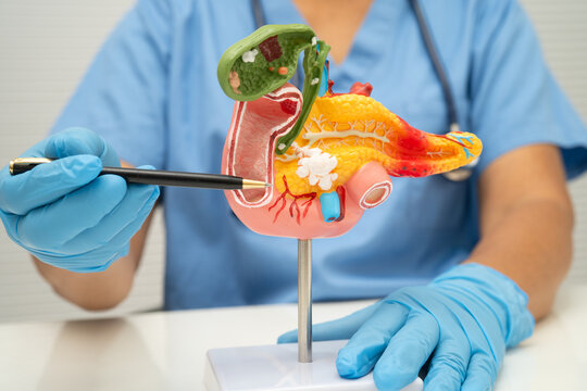 Pancreatitis, pancreatic cancer, Asian doctor with pancreas, gallbladder and bile duct human anatomy model at hospital.