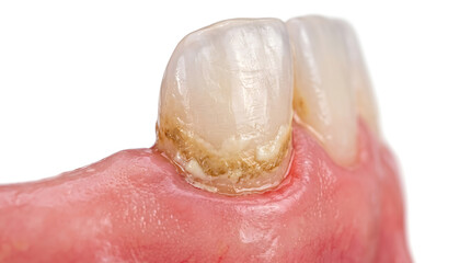 Fototapeta premium Side View Close Up of Discolored Tooth Enamel and Receding Pink Gums