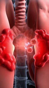 Human lungs with inflamed tissue, infected regions, and glowing viral particles interacting with immune response cells inside a transparent ribcage, ideal for pulmonology, respiratory health, medical