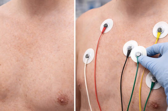Medical electrocardiogram electrodes attached to male chest during cardiac monitoring examination