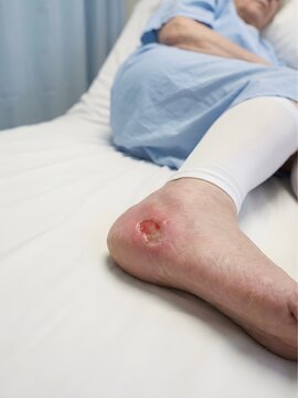 Close Up Of Pressure Sore On Elderly Patient Heel
