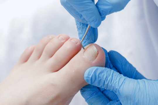 Podiatrist performing toenail care on caucasian adult female foot
