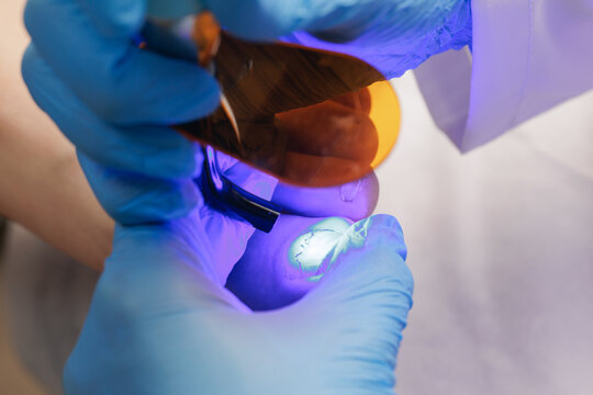 Podiatrist performing foot treatment with uv light and protective eyewear secures brace titanium